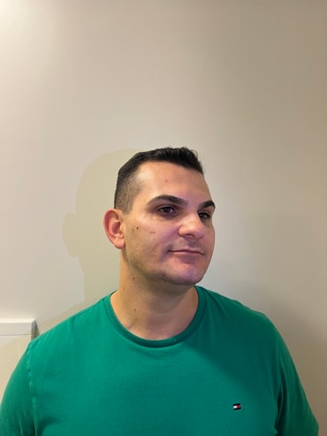 Zéfo depois da harmonização facial - sem barba